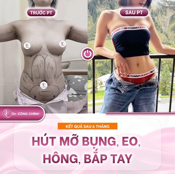 lipo-xshape-4-1778893710.jpg